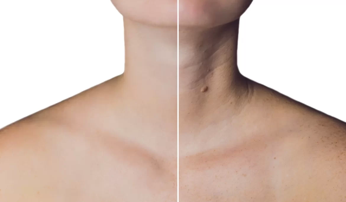 botox pescoço Goiânia